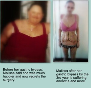 gastric bypass-1